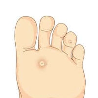 Foot Care Callus Removal