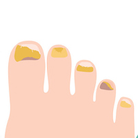 Foot Care , Nail Fungus Treatment